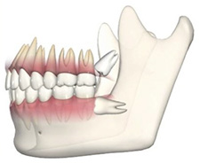 gömülü dişlerin cerrahisi