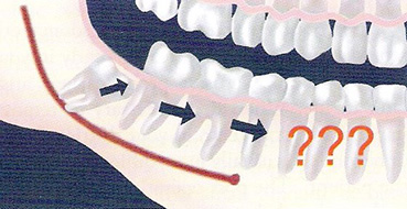 ortodontik amaçlı diş çekimi